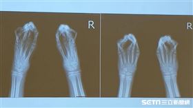 患者張子墨術前X光檢查影像，可見手掌五指骨併連。（圖／記者楊晴雯攝）