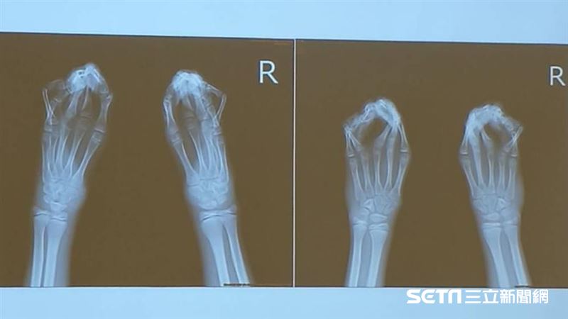 他出生「鴨掌手」！15年來無法抓握
