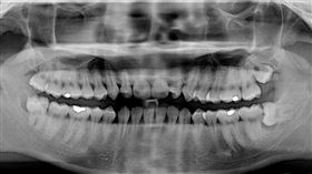 智齒(維基百科)