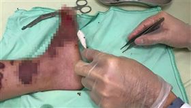 女大生摔車腳受傷未換藥，導致傷口爬滿蛆。（圖／沈彥廷醫師提供）