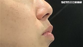 黑眼圈、嘴唇變黑都中 4種臉部異狀恐是癌