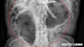 從X光影像可見該名80歲老翁嚴重腸扭轉成「咖啡豆」狀。（圖／亞大醫院提供）