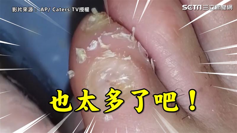 超舒壓！死皮變嫩膚 醫師曝過程