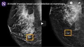 谷歌（Google）研發的人工智慧系統透過乳房X光攝影判讀女性是否罹患乳癌的表現，已達放射科專家水準，檢測失誤率也可望降低。(youtube截圖)