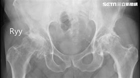 童綜合醫院,骨科部,謝國顯,股骨,缺血性壞死,髖部人工關節,置換手術
圖/童綜合醫院提供