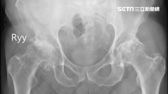 愛喝酒+運動過度　男子大腿骨全壞死