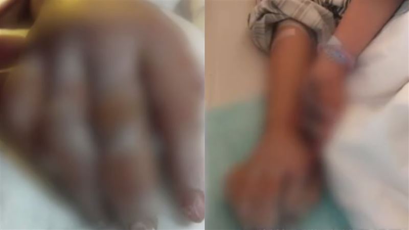國中女校內掃雪手發黑　醫：恐要截肢