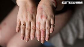 中醫,袁國山,皮膚癢,乾癬,跨年,皮膚科
圖／袁國山中醫師提供