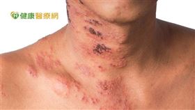 曾得過水痘、年紀大以及糖尿病、腎臟病、免疫缺乏者等都是高危險群，增加帶狀疱疹發作風險。