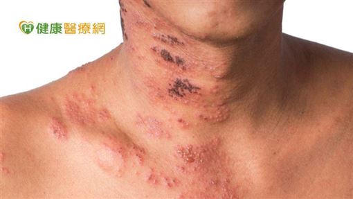 曾得過水痘、年紀大以及糖尿病、腎臟病、免疫缺乏者等都是高危險群,增加帶狀疱疹發作風險。