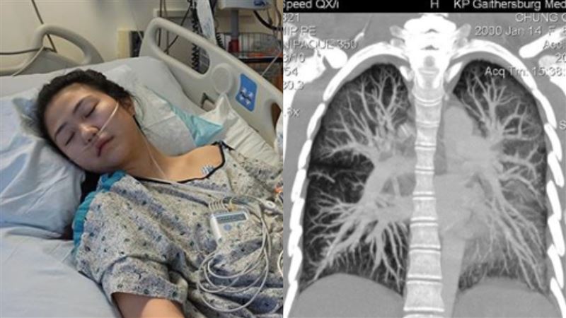 19歲女吸電子菸肺爛命危　發勸世文