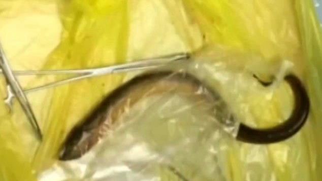 男腹痛掛急診…醫腸道拉出2條活鱔魚