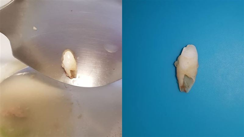 喝骨仔肉湯驚見爛牙　網竟安慰：正常