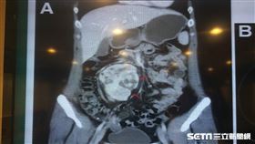 電腦斷層影像顯示患者右側長了一顆約9公分大的良性腫瘤，竟是罕見的腹部單中心淋巴增生性疾病(Castleman/城堡人疾病)。（圖／記者楊晴雯翻攝／北醫提供）