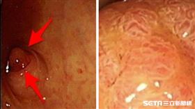 息肉(錢政弘醫師提供)