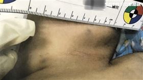 台南滿月男嬰遭父親毆打傷勢圖（翻攝畫面）