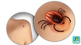 名家專用／NOW健康／萊姆病是由野外蜱蟲帶給人類的疾病，早期治療可以痊癒，發展至中後期，恐怕出現終身病症。(勿用)