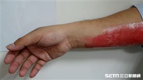 燒燙傷示意圖。（圖／奇美醫院提供）