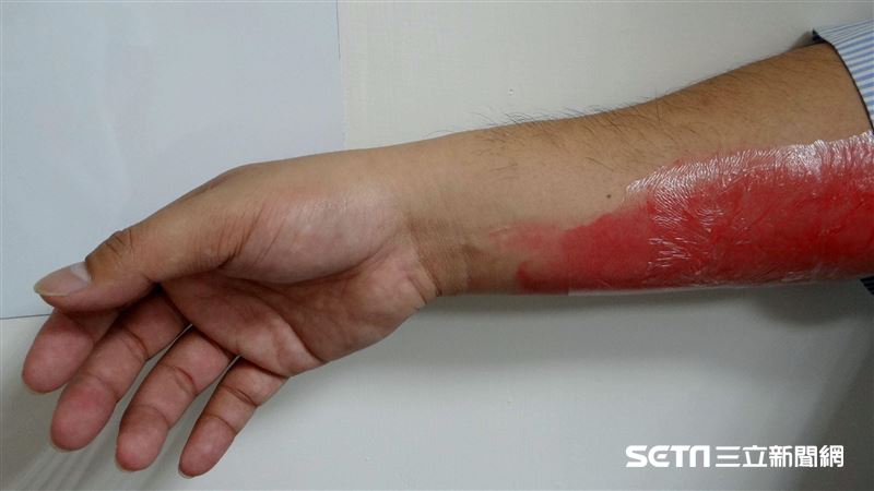 天冷吃鍋燒燙傷　只能用「1招」急救