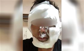 瓦斯罐滾入火堆爆炸，男肉身護童被燒傷。　