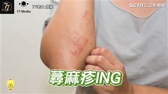 蕁麻疹發作？網紅醫師教你改善攻略