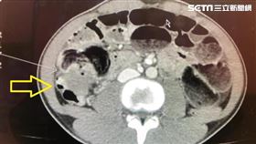 大腸癌（白永嘉提供）