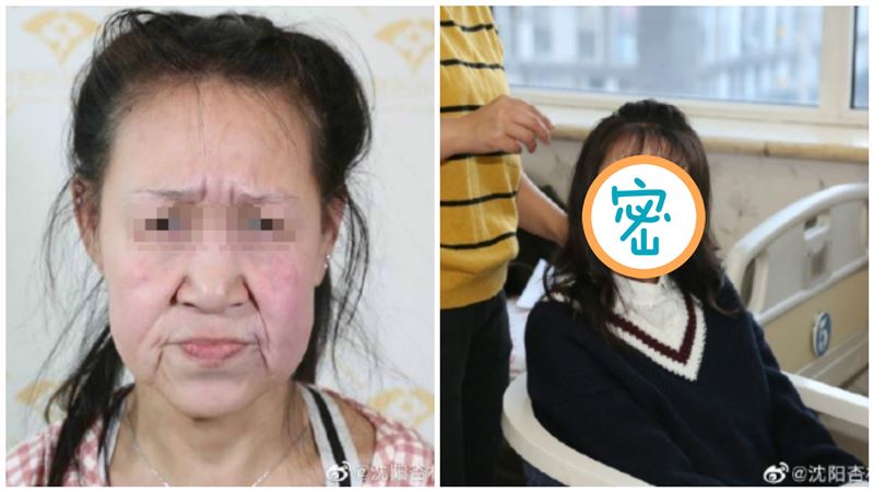 少女滿臉皺紋遭霸凌　整形後全場驚呆