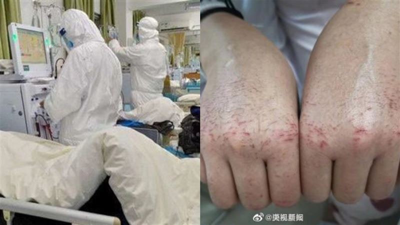 武漢22歲女護士雙手爆血：前線要我