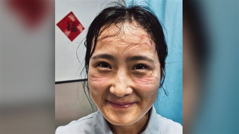 一線女醫護滿臉勒痕　網淚：最美天使