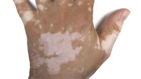 女大生罹患不明白班變「人形乳牛」。（非當事者）(示意圖／凱格蘭公關提供)