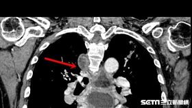 該患者食道充滿食物殘渣。（圖／亞大醫院提供）