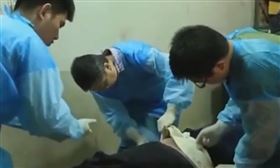 武漢肺炎,解剖,病理,鍾南山,肺部,纖維化,黏液