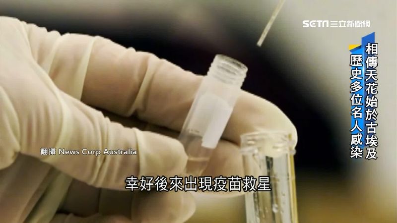 唯一被消滅病毒　天花曾奪3億人性命
