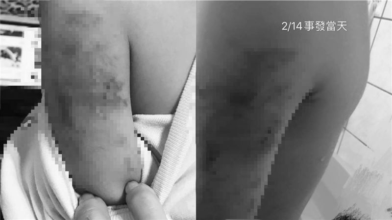 外師拽出門手臂全黑！母控幼園虐童