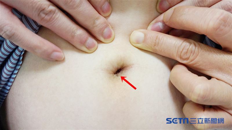 迷你單孔腹腔鏡切息肉　預防膽囊癌