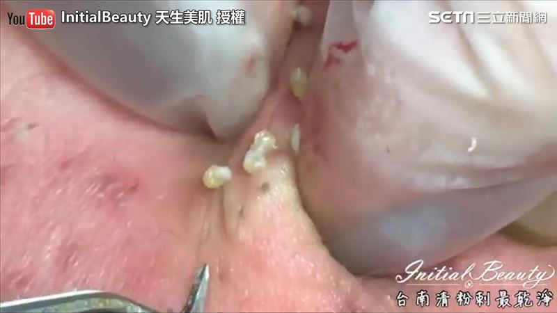 療癒！背部粉刺狂擠六連發