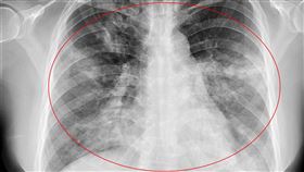 該患者肺部遭感染，使得小血管通透性增加，發生破裂而引發咳血。（圖／亞大醫院提供）