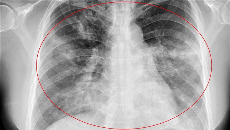 肺炎死者解剖：氣道和肺部損傷為主