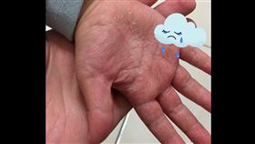 消毒,防疫,次氯酸水,傷害,接觸皮膚,幼稚園,校方,女兒,接觸性皮膚炎