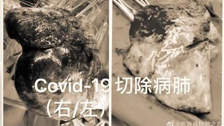 武漢肺炎患者換肺首例　恐怖病狀曝光