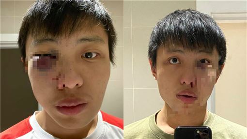 你這個武漢肺炎 留英華人街頭遭圍毆眼鼻爆血得整形 國際 三立新聞網setn Com