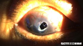 角膜破洞（北市聯醫提供）