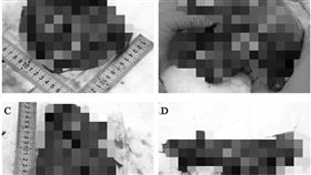 武漢肺炎,病理報告,肺部,壞死（圖／翻攝自澎湃新聞）