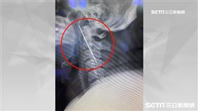 李家和案例/鋼釘