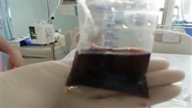 （圖／翻攝自澎湃新聞）中國,東莞,血尿,醬油色