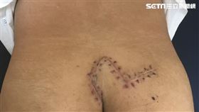 亞洲大學附屬醫院,整形外科,鄭旭棠,潛毛症,藏毛竇,吉普車病