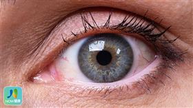 名家專用／NOW健康／頸動脈海綿狀竇廔管造成的紅眼症狀為結膜上一條條螺旋狀膨大的血管，仔細看仍可一般結膜炎做區分。(勿用)