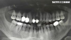 蛀牙(記者陳弋攝影)
