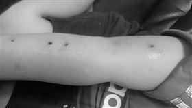 新北市,新北市社會局,虐童,兒虐,菸燙