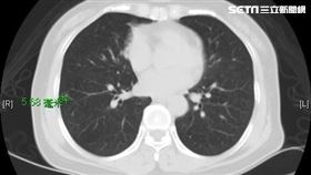 亞洲大學附屬醫院,胸腔外科,劉柏毅,癌症,肺癌,肺腺癌